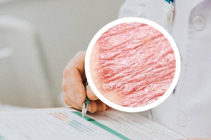 绿豆煮水能治好牛皮癣吗