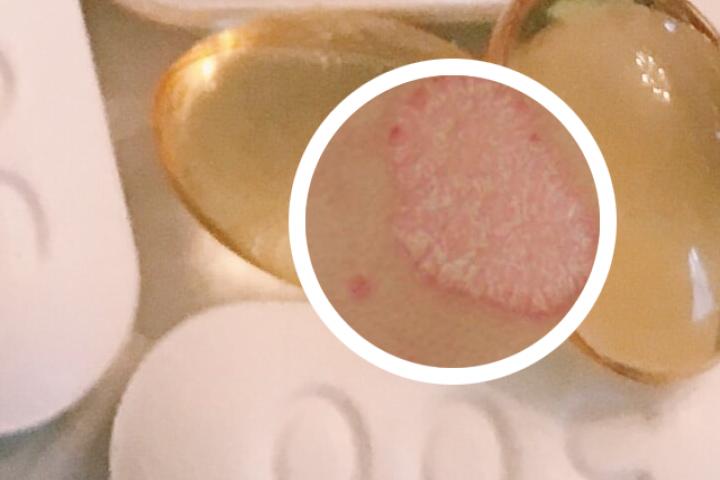 光疗对银屑病效果好吗