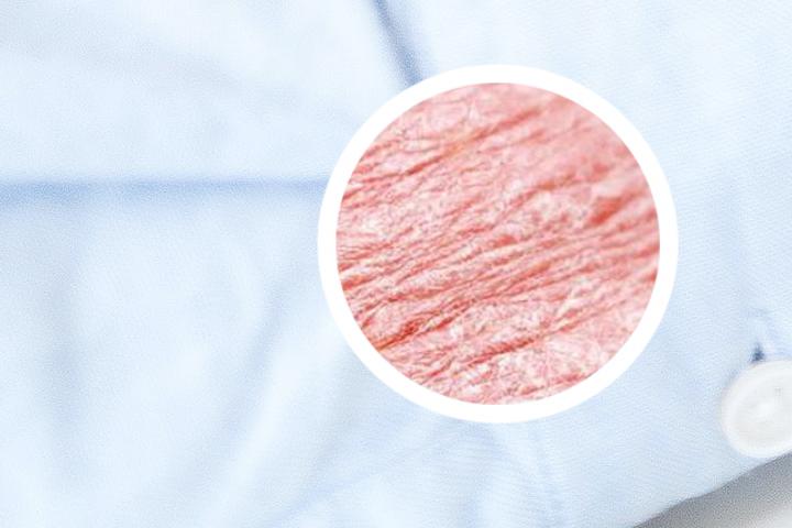 银屑病有救了