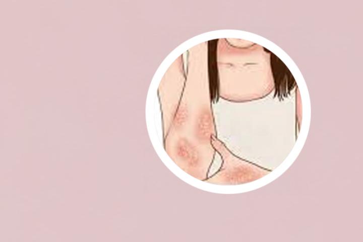 银屑病会变白头吗