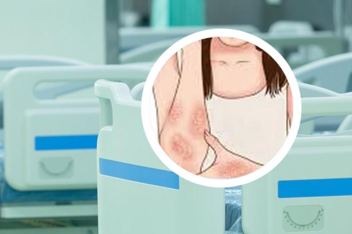丘疹型银屑病