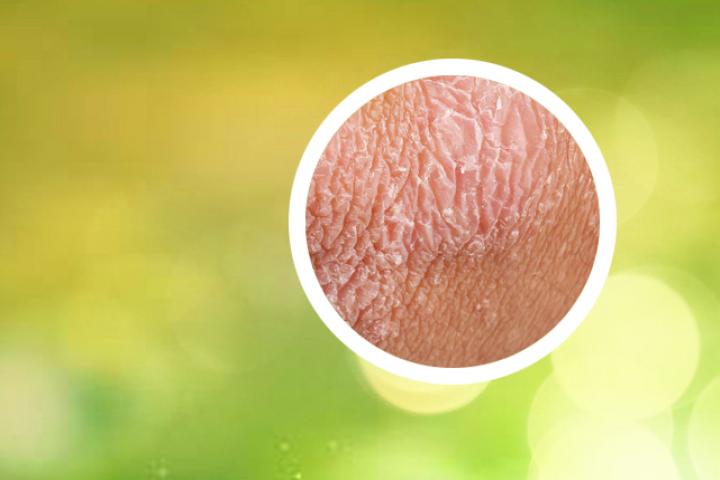 反向银屑病生物制剂