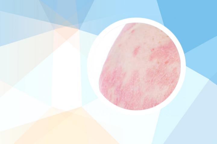 牛皮癣洗澡时用什么比较好