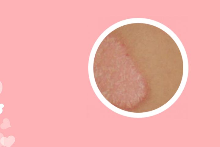 金肤王抑菌乳膏治牛皮癣吗