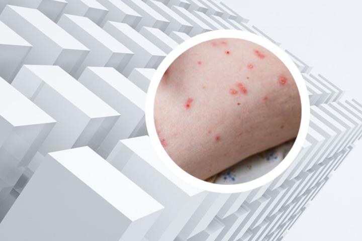银屑病能否通过光疗加补骨脂治疗取得显著效果