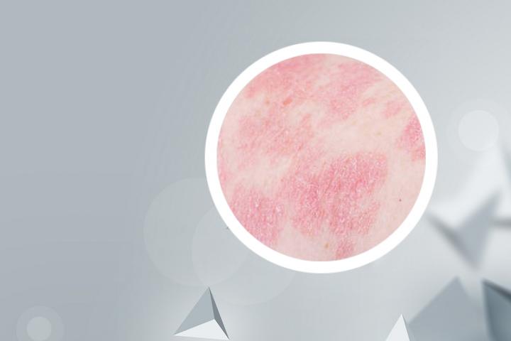 维生素c治好了银屑病