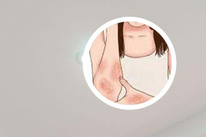 绳疗法治疗银屑病