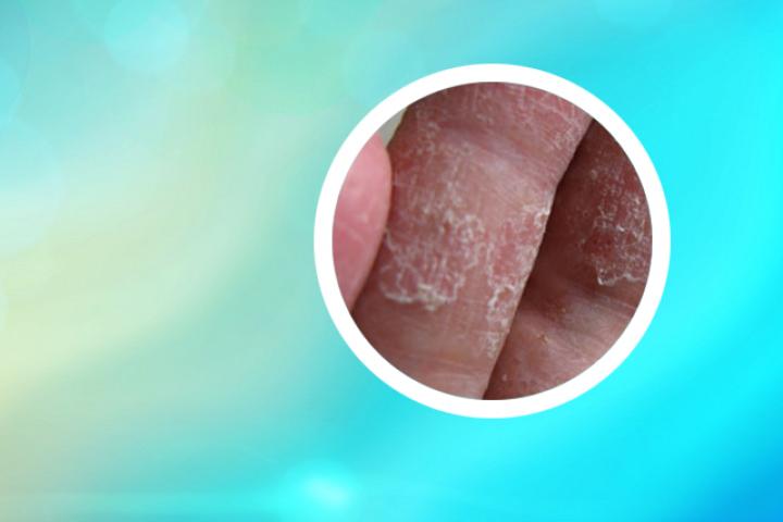 银屑病薏米水