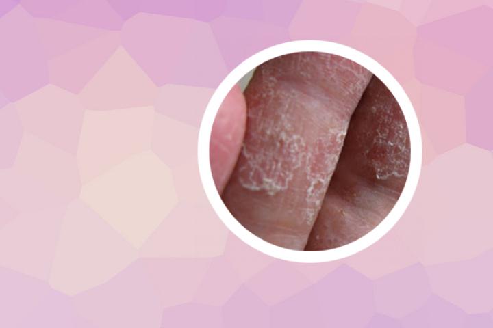 银屑病滑膜炎能否彻底根治好呢