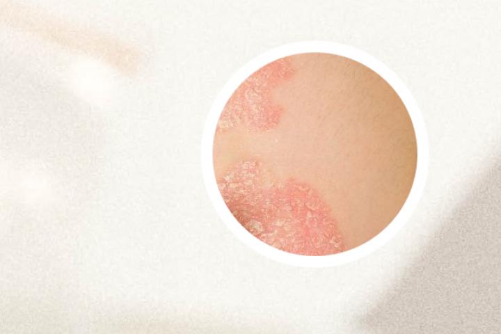 同济银屑病专家排名表如何查询