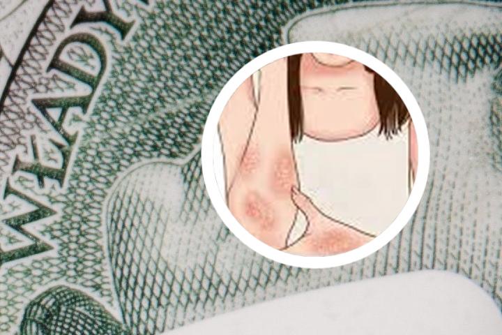 治银屑病的针管用吗