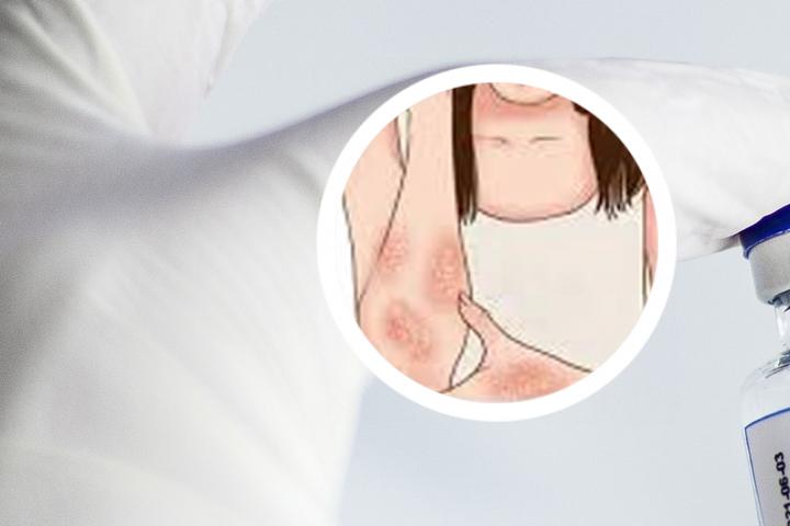 阴部银屑病需要特殊治疗吗