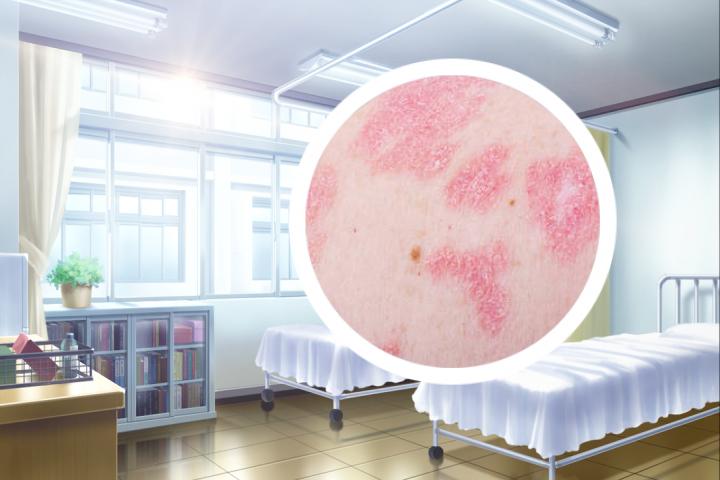 莫匹罗星软膏能否完全治愈银屑病