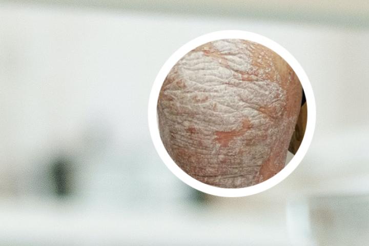艾灸治牛皮癣吗