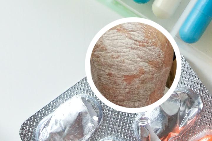 银屑病疯长
