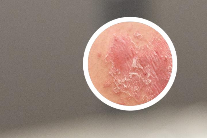 银屑病打白蛋白效果怎样