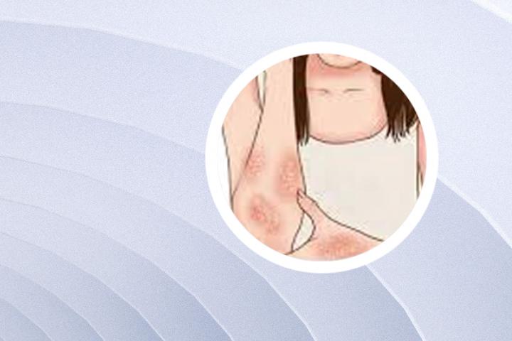 艾滋病和银屑病皮肤区别