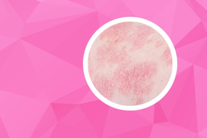 银屑病有根治的案例么