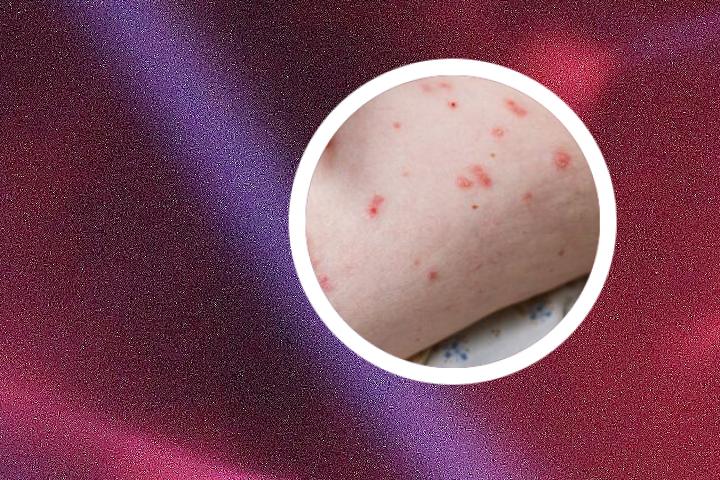 我用偏方治好了银屑病