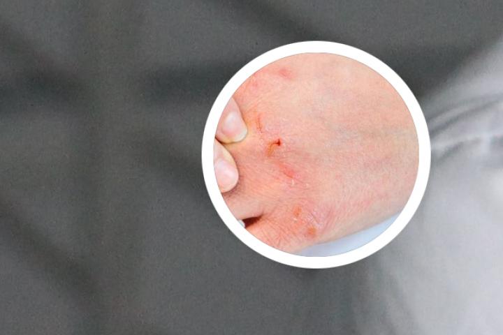 mtx药物能拿来治疗银屑病嘛