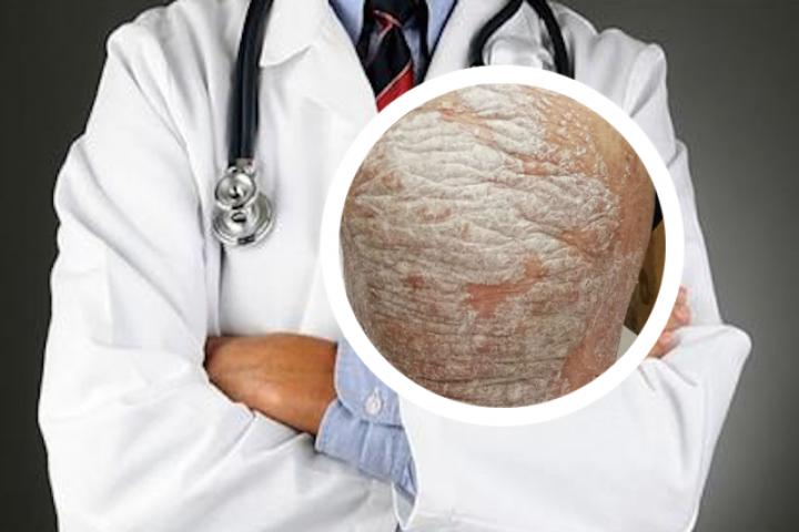 银屑病患者饭后需要注意些什么