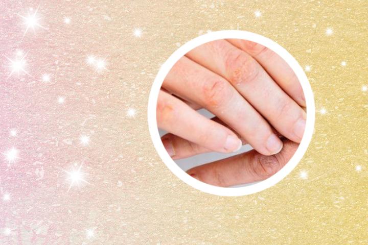 青少年银屑病会自愈吗