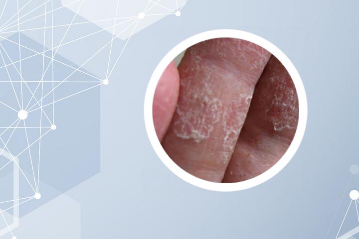 银屑病可以用艾草洗吗