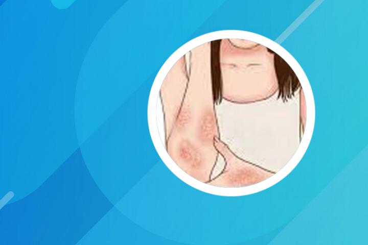 银屑病Scc指