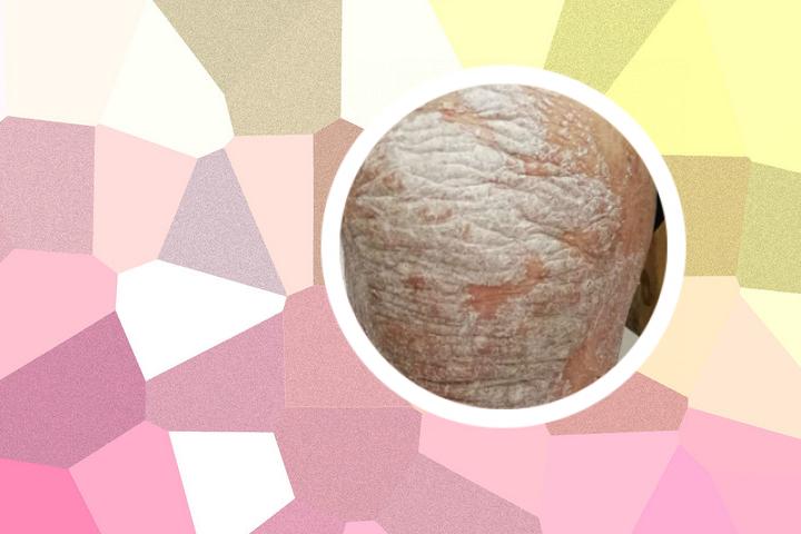 请问中医是否能治愈银屑病