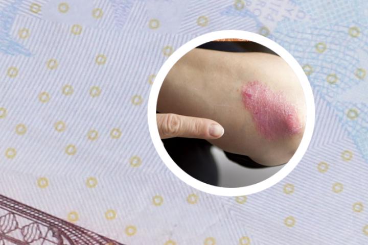 阿司匹林会加重治疗银屑病吗