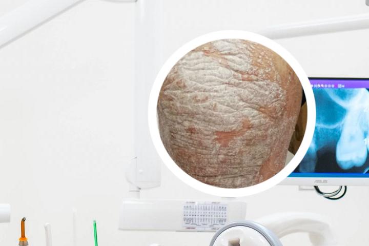 小苏打白醋治牛皮癣