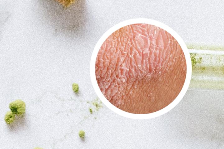 使用皮康王能否有效治疗银屑病