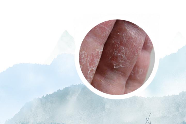 校园牛皮癣清理志愿活动