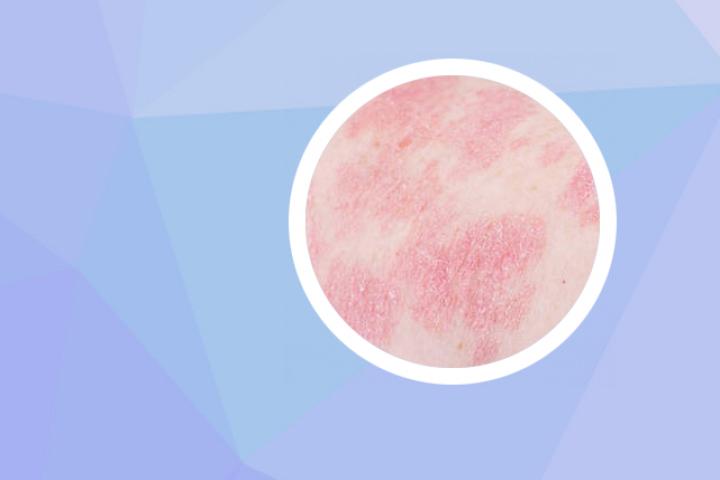 银屑病必须都长出来