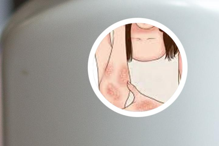 皮癣和牛皮癣如何区分