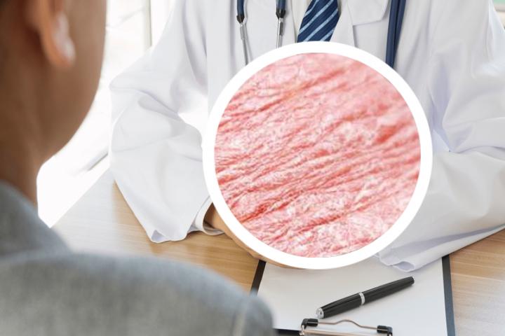 银屑病生物制剂