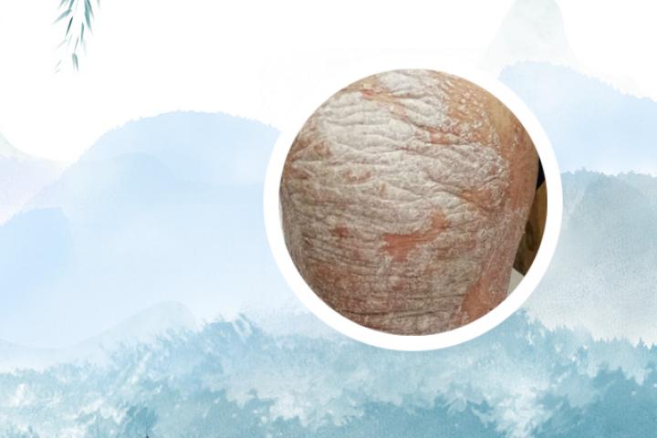 宝宝银屑病的头皮怎么治疗