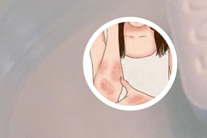 牛皮癣吃黄豆芽