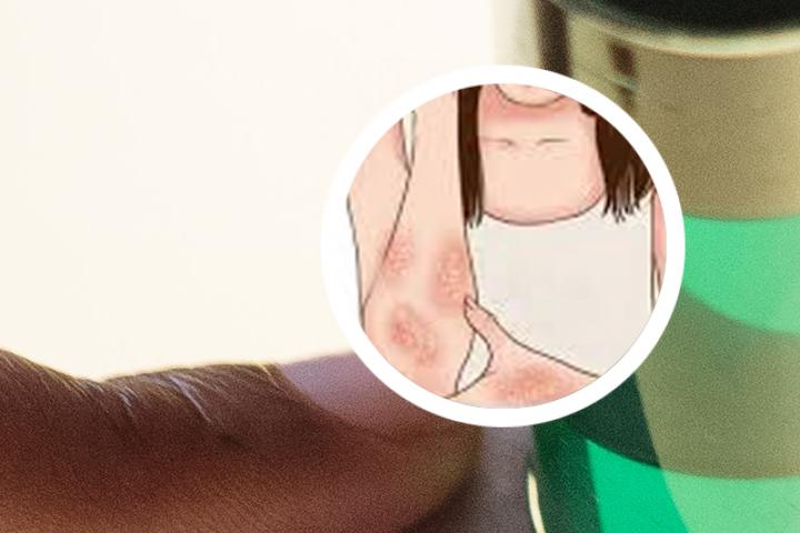 紫外线光疗仪能治银屑病吗