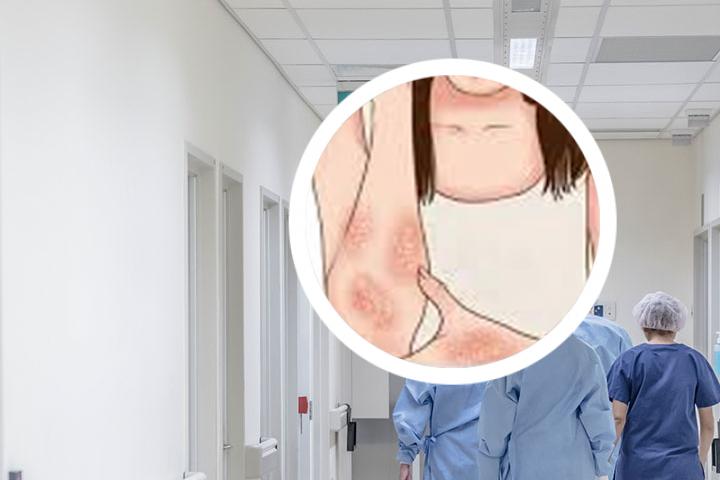 银屑病红一阵