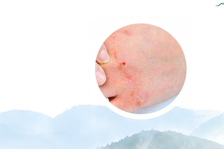 银屑病恶化偏方大全