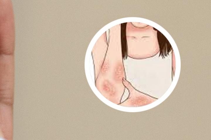 银屑病有救了