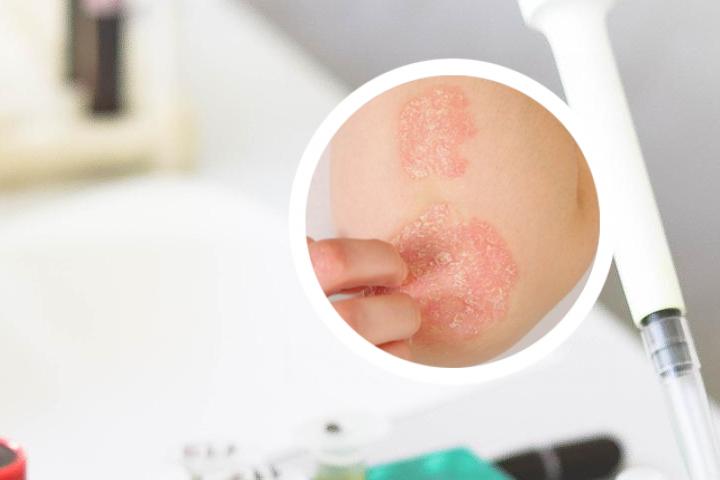 拔智齿治疗银屑病