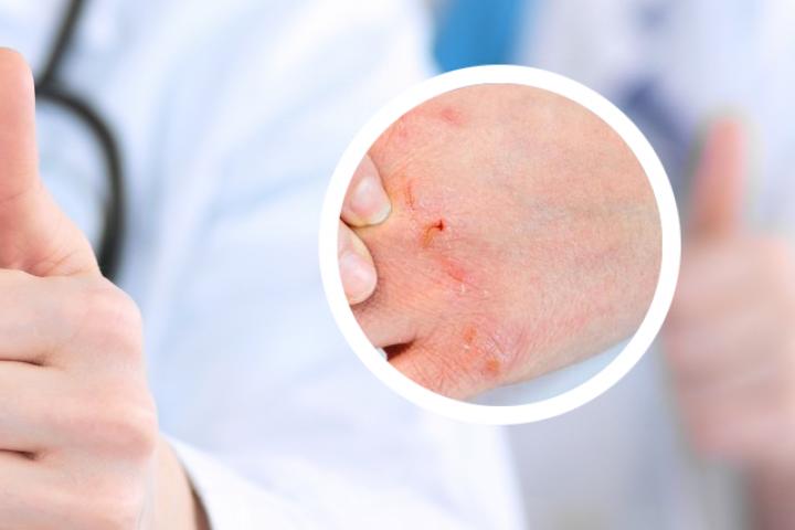 银屑病治疗最新突破