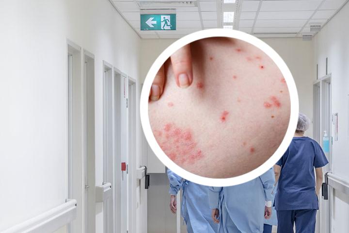 银屑病能用蒲公英泡澡吗