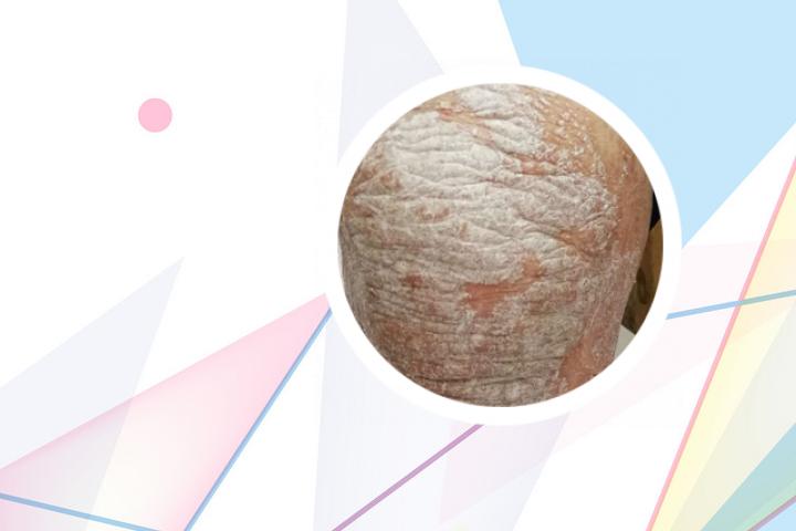 治牛皮癣的常用药膏