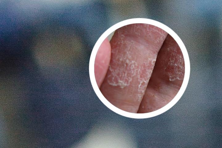 创伤性牛皮癣每天多次涂抹维