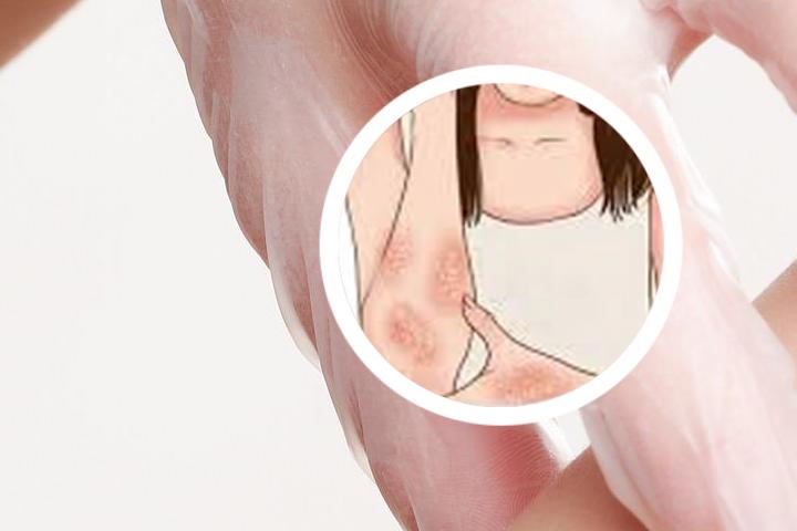 银屑病泡澡自愈靠谱吗