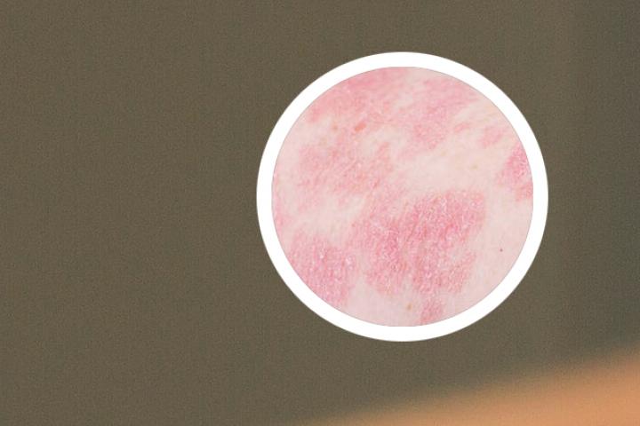 牛皮癣寻常型可以治好吗