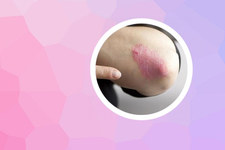 阿维a治疗点滴状银屑病